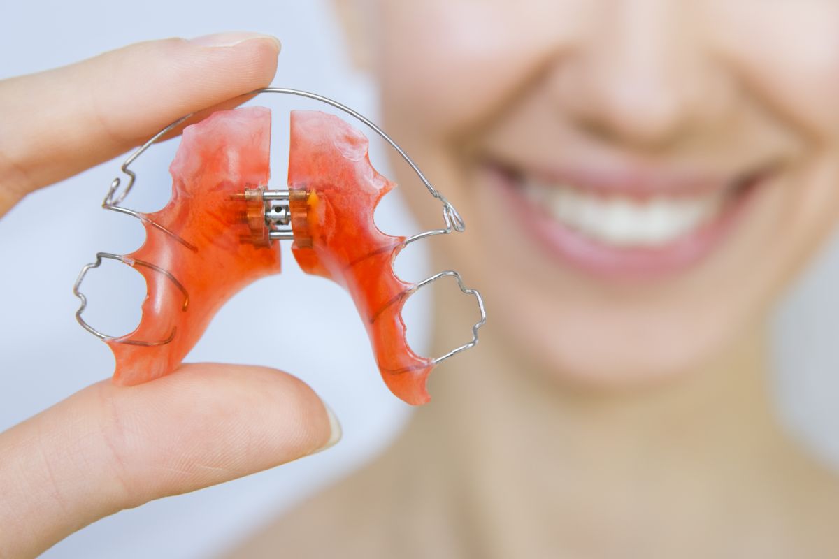 Expanders for Teeth: Power Your Smile with Effective Devices!