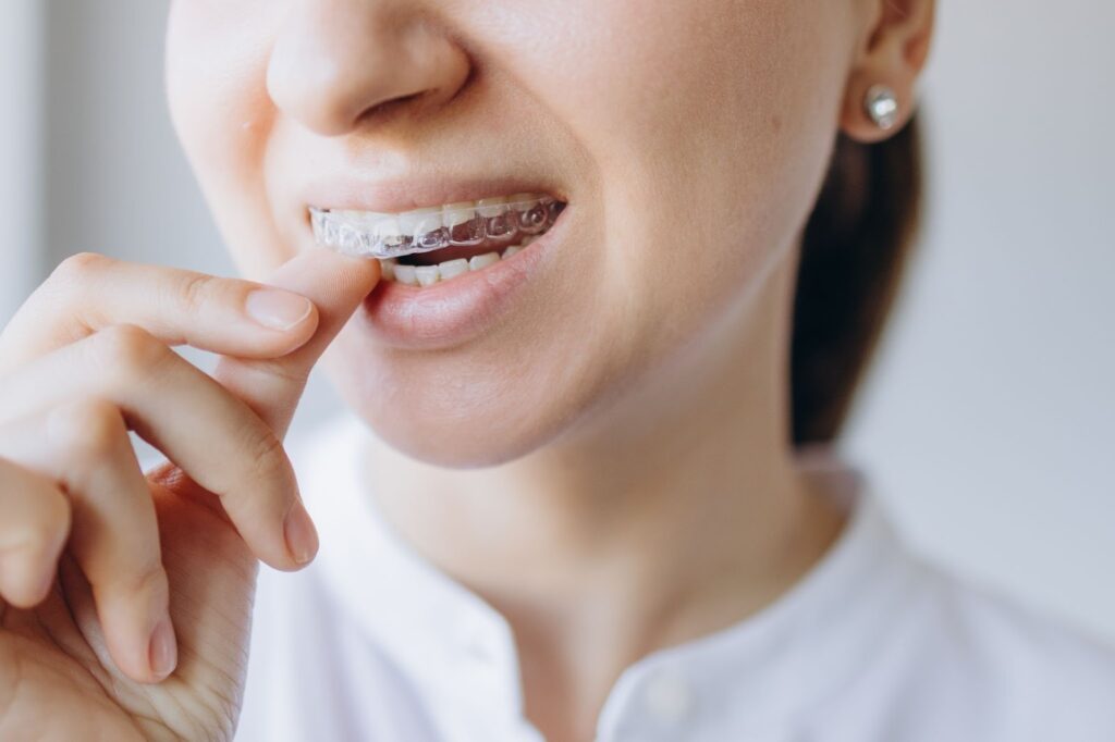 Everything You Need to Know About Retainers