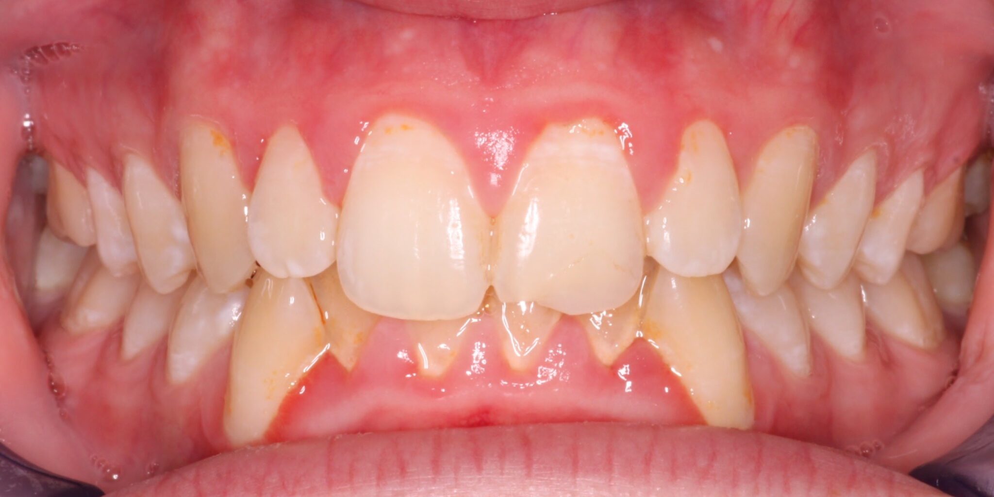 braces sammamish