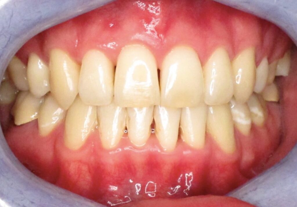 Luke Teeth After