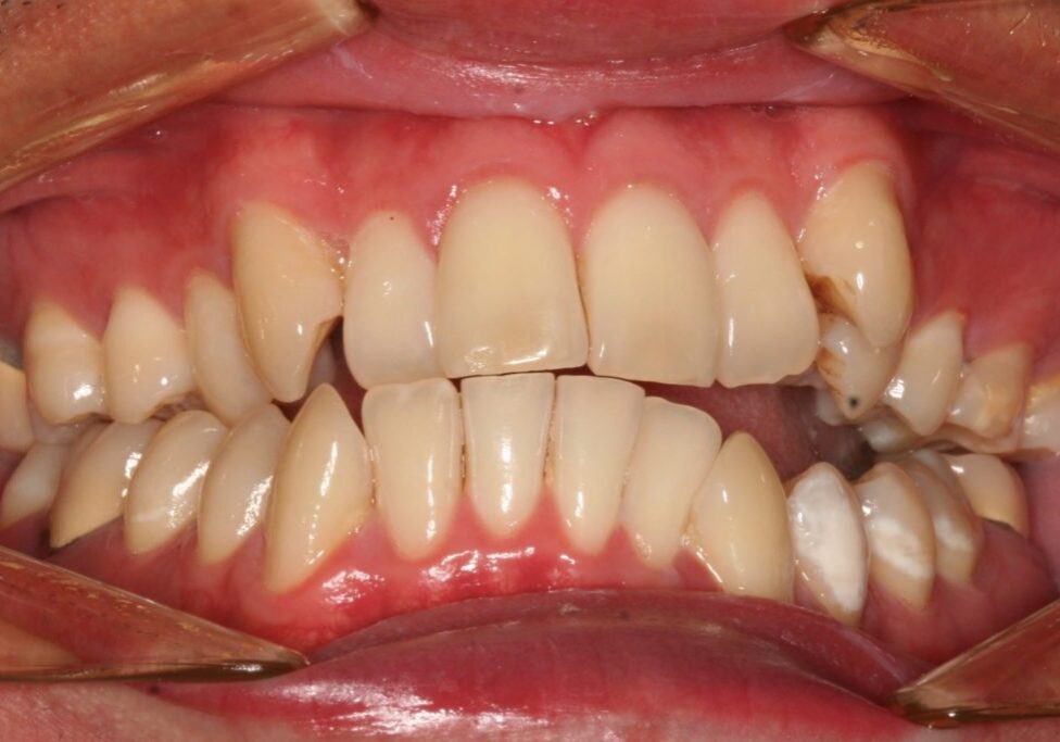 Luke Teeth Before