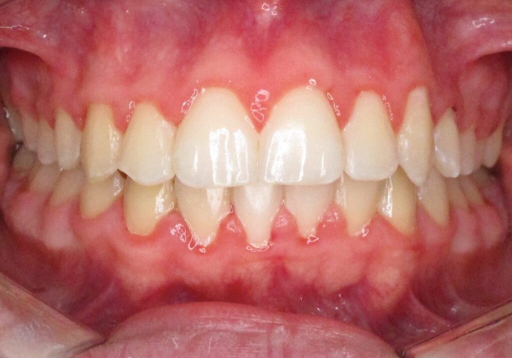 Maxim Teeth After