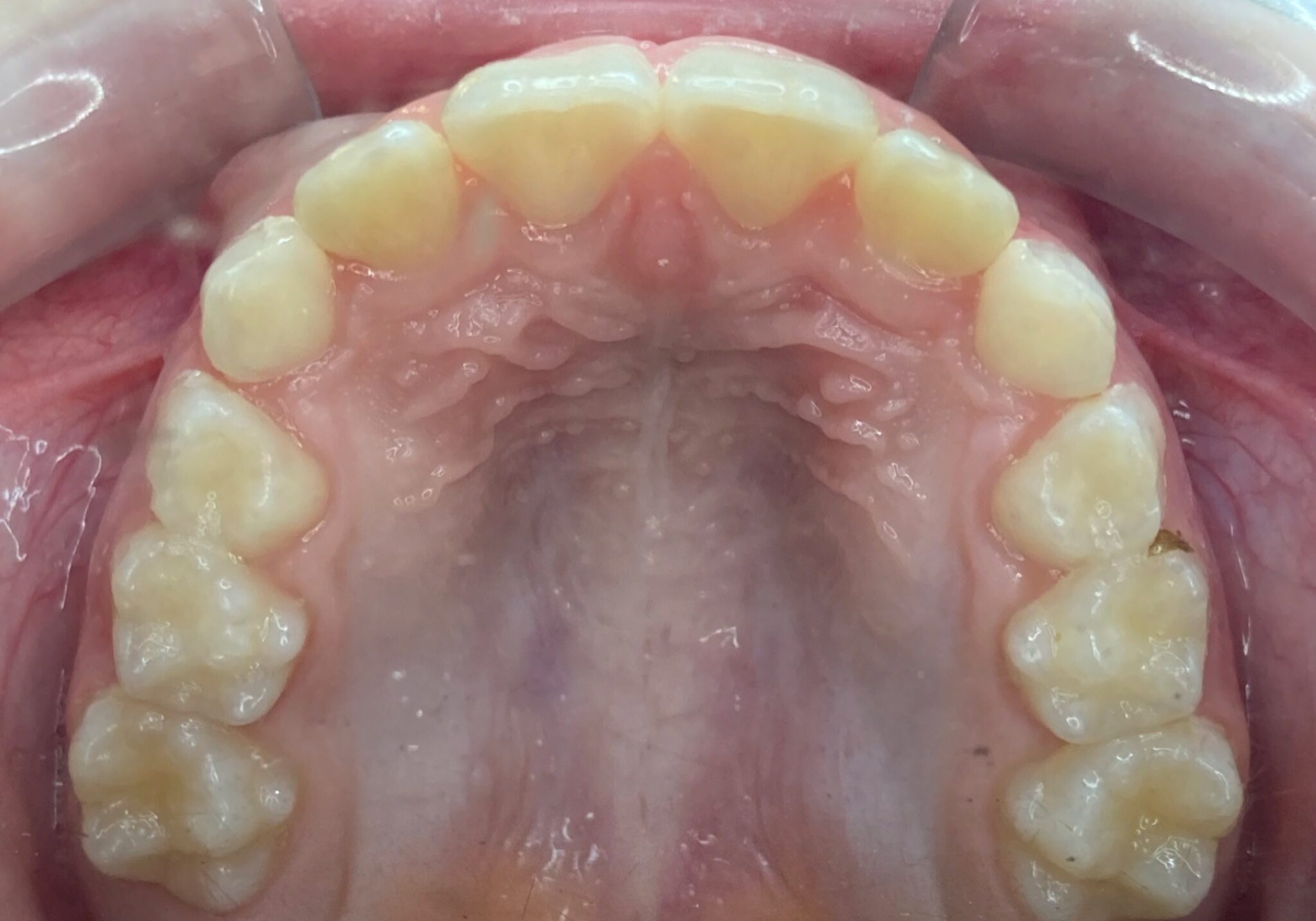 braces sammamish
