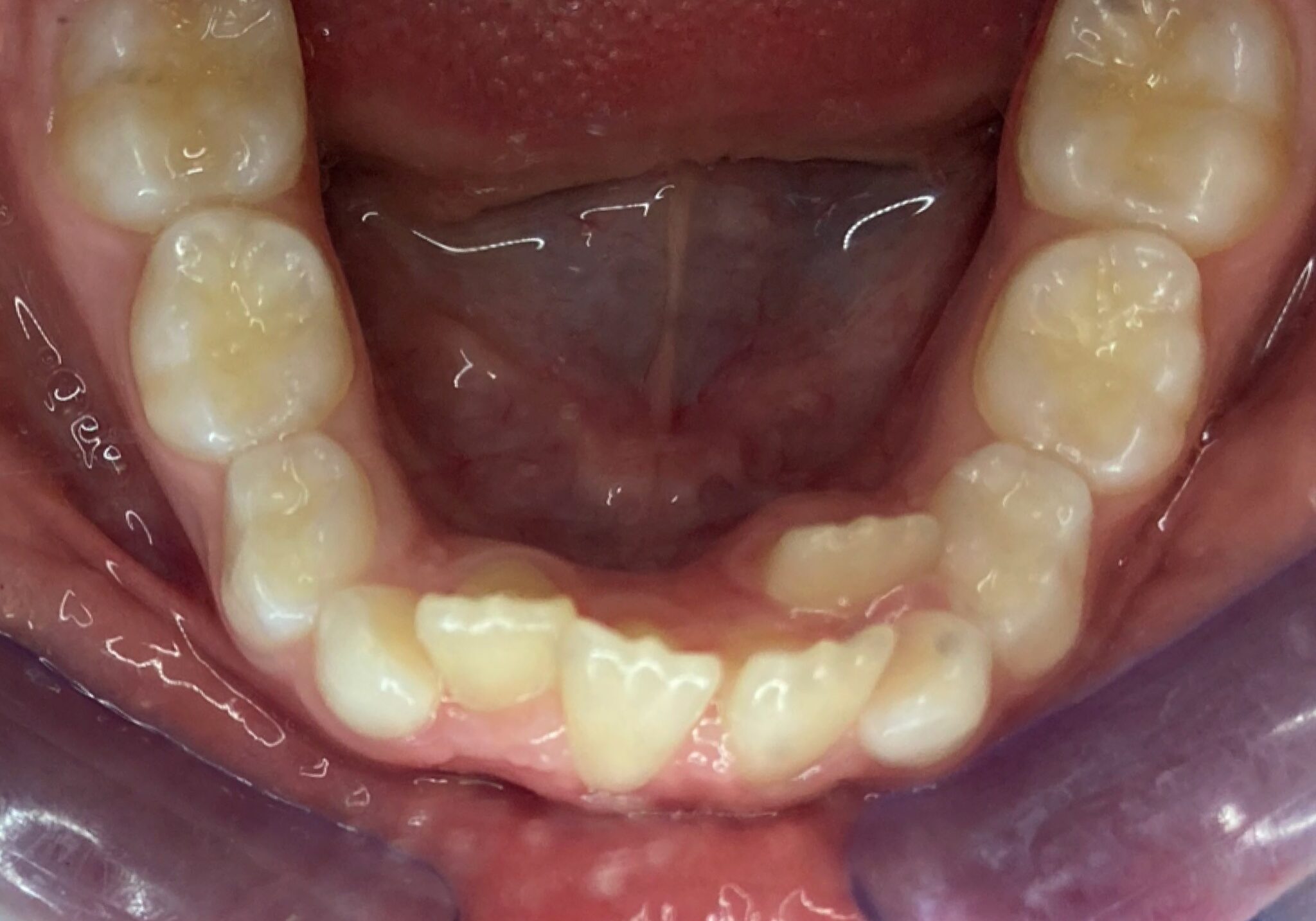 braces sammamish
